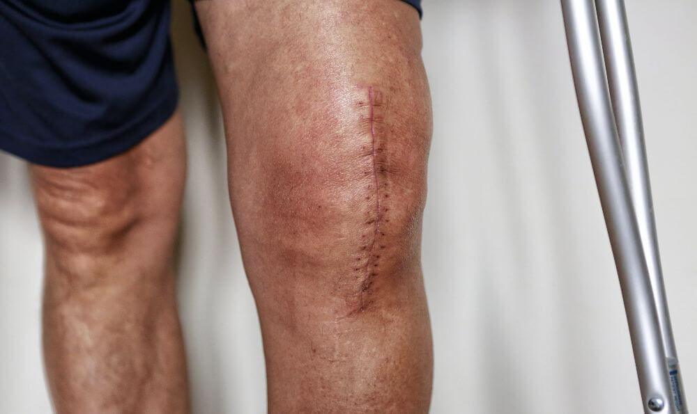 knee with surgical incision after knee replacement